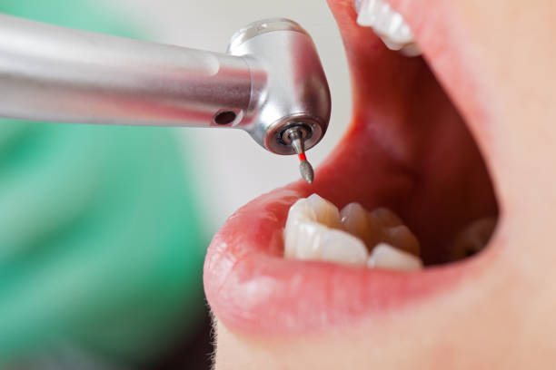 Best Emergency Tooth Extraction in Comer, GA